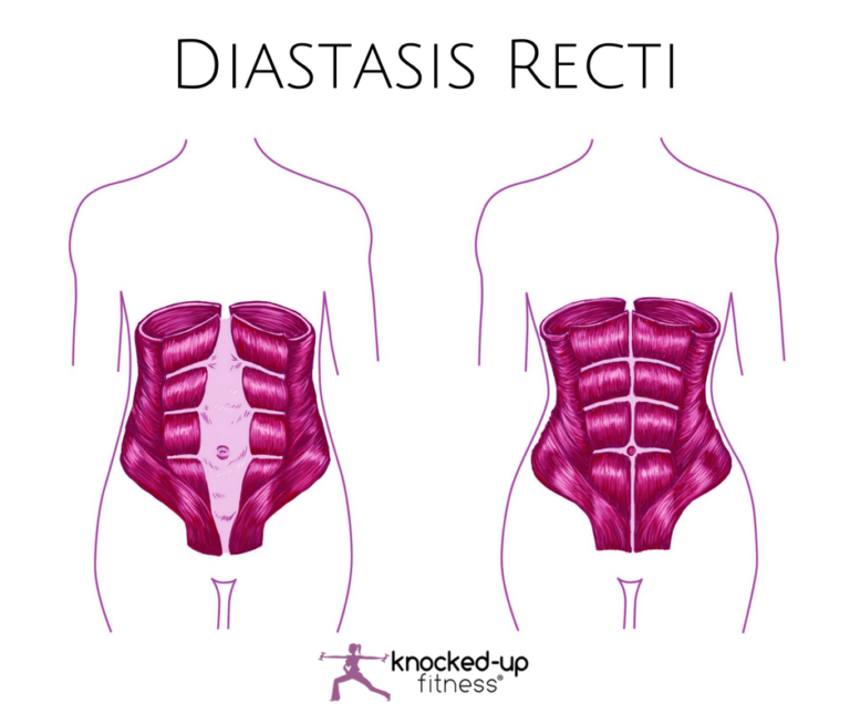 Diastasis-Recti.png